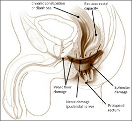 Causes of faecal incontinence