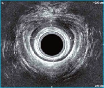 Endoanal ultrasound image of anal sphincters in faecal incontinence
