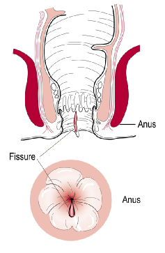 Diagram of rectum and anus with closeup of anal canal with acute anal fissure