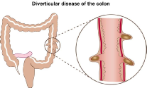 Diagram of diverticular disease