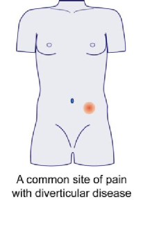 common site of pain with diverticular disease