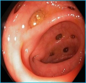Colonoscopic view of diverticular disease