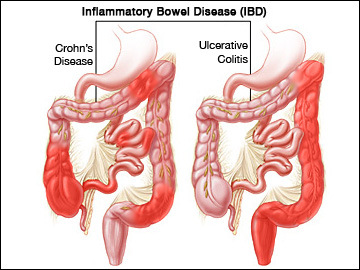 Differances in distribution of inflammation between ulcerative colitis & Crohns disease