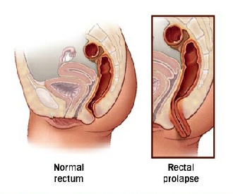 Normal pelvis and patient with a rectal prolapse