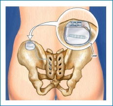 Diagram if a permanent sacral nerve stimulator in place, with a lead travelling form the stimulator into one of the holes in the sacral bone.