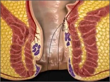 The continuous mucosal stich into prolapsing haemorrhoidal tissue has been tied, leading to a 'lift' of the tissue, preventing it from prolapsing during bowel motions
