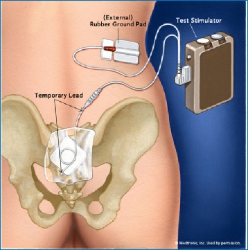 https://www.colorectalcentre.co.uk/images/Test_SNS_stimulator.JPG