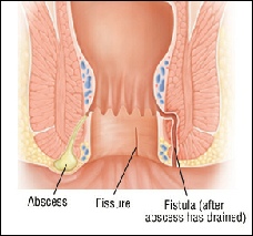 With perianal fistulas