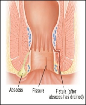 Anal abscess and anal fistula