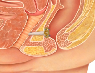 Biodesign fistula occluding a recto-vaginal fistula