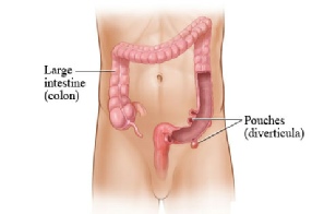 Colon and diverticular disease of the sigmoid colon