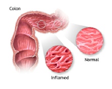 Inflamed and normal colon in IBD
