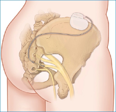 Sacral nerve stimulation with stimulator and wire stimulating sacral nerve on right side