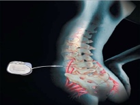 Sacral nerve stimulation