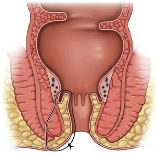 Seton drain in a fistula in ano