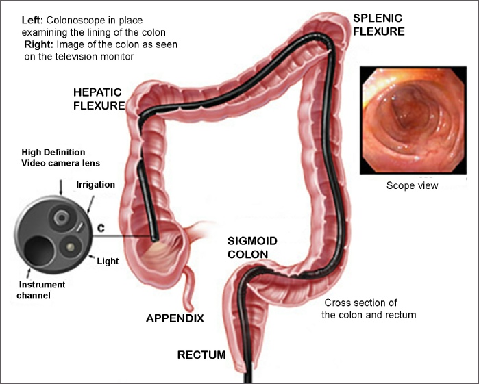 Colon and rectum containing a colonoscope, a view of the end of a colonoscope and a view of the colon during a colonoscopy