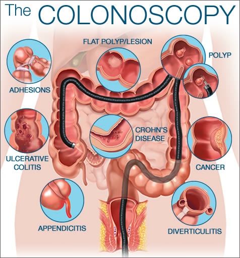 Colon and rectum of a patient undergoing a colonoscopy. The colon is diseased with diverticulitis, colon cancer, colon polyps, adhesions, ulcerative colitis, and Crohn's disease