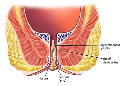 Diagram of anal canal with anal fissure and a sentinal pile (sentinal skin tag)