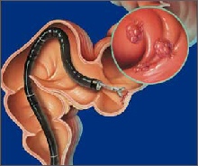 Diagram of a colon with a colonoscope and a biopsy of a colonic polyp