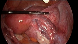 Laparoscopic view of the pelvis including the ovary, uterus and fallopian tubes