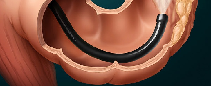 Screening colonoscopy