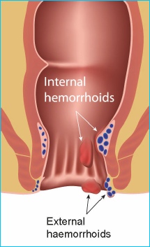 Piles: View Causes, Symptoms and Treatments