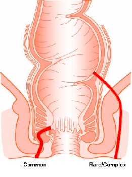 Picture of a rectum and anus showing a simple and complex fistula in ano