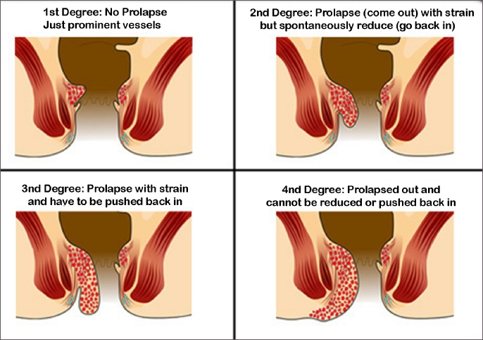 Piles: View Causes, Symptoms and Treatments