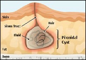 Pilonidal sinus