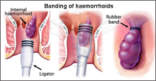 Rubber Band Ligation of haemorrhoids. Picture displays haemorrhoid before, during banding and after banding
