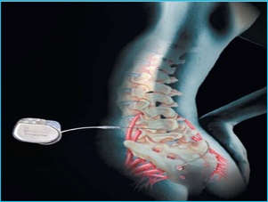 Diagram of Sacral Nerve Stimulation