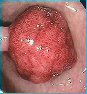 Colonic polyp